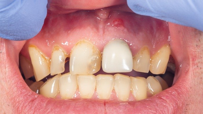 Are your teeth yellow even after brushing them every day? Find out how to fix it. || ପ୍ରତିଦିନ ବ୍ରଶ୍ କରିବା ପରେ ବି ଆପଣଙ୍କ ଦାନ୍ତ ହଳଦିଆ? ଏହାକୁ କିପରି ଠିକ କରିବେ ଜାଣନ୍ତୁ